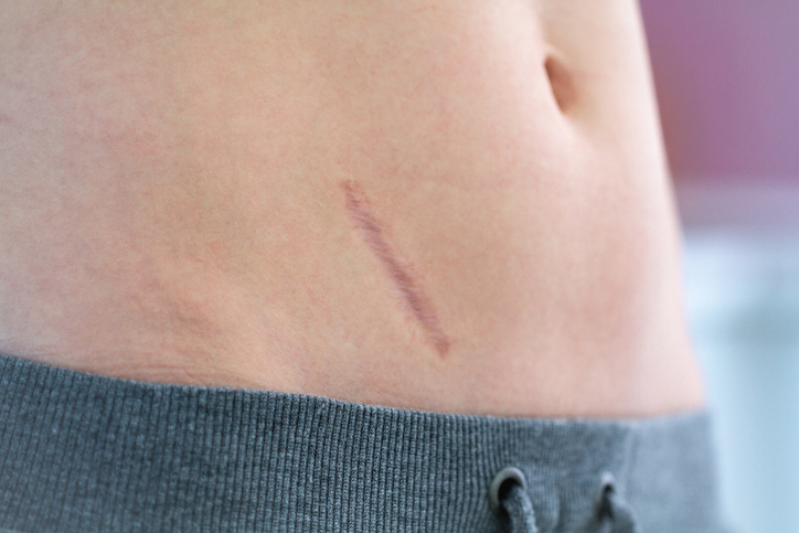 Can I Sue For a Scar?